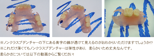 ※ノンクラスプデンチャーの下にある青字の線が透けて見えるのがおわかりいただけますでしょうか！？※これだけ薄くてもノンクラスプデンチャーは弾性があり、柔らかいため丈夫なんです。柔らかさについては以下の動画からご覧ください！